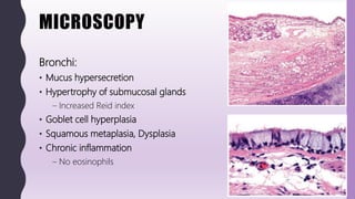 MICROSCOPY
Bronchi:
• Mucus hypersecretion
• Hypertrophy of submucosal glands
– Increased Reid index
• Goblet cell hyperplasia
• Squamous metaplasia, Dysplasia
• Chronic inflammation
– No eosinophils
 