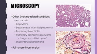 MICROSCOPY
• Other Smoking-related conditions:
– Anthracosis
– Emphysema
– Desquamative interstitial pneumonia
– Respiratory bronchiolitis
– Pulmonary eosinophilic granuloma
• “Langerhans cell histiocytosis”
– Usual interstitial pneumonia
• Pulmonary hypertension
 