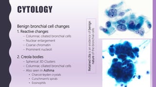 CYTOLOGY
Benign bronchial cell changes
1. Reactive changes
– Columnar, ciliated bronchial cells
– Nuclear enlargement
– Coarse chromatin
– Prominent nucleoli
2. Creola bodies
– Spherical 3D Clusters
– Columnar, ciliated bronchial cells
– Also seen in Asthma
• Charcot-leyden crystals
• Curschmann's spirals
• Eosinophils
Retainedciliaisanevidenceofbenign
natureofthebronchialcells
 