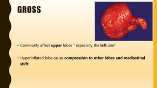 GROSS
• Commonly affect upper lobes “ especially the left one”
• Hyperinflated lobe cause compression to other lobes and mediastinal
shift
 