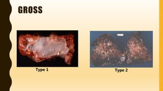 FlashPath - Lung - Congenital Pulmonary Airway Malformation | PPTX