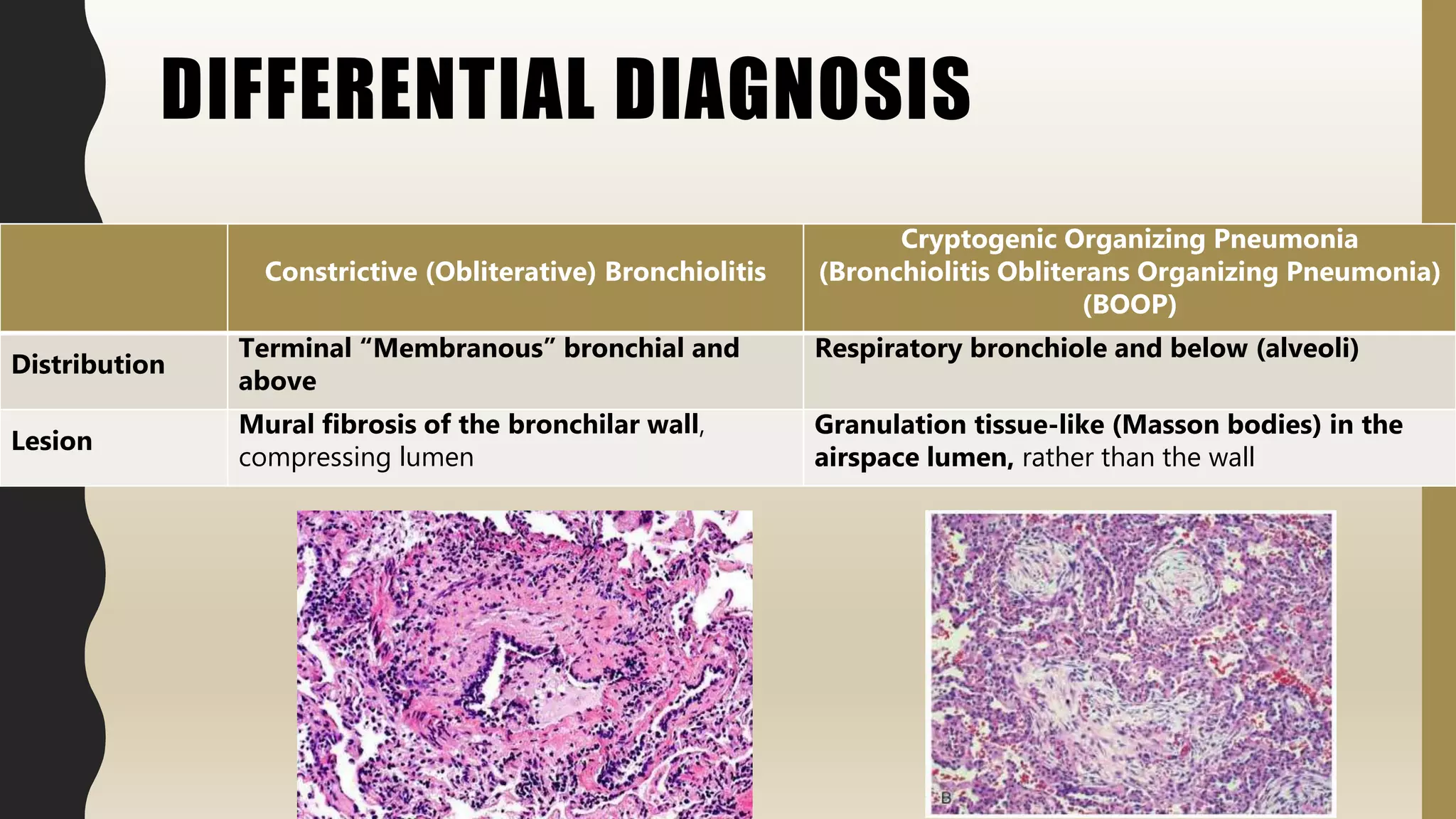 DIFFERENTIAL DIAGNOSIS
Constrictive (Obliterative) Bronchiolitis
Cryptogenic Organizing Pneumonia
(Bronchiolitis Obliterans Organizing Pneumonia)
(BOOP)
Distribution
Terminal “Membranous” bronchial and
above
Respiratory bronchiole and below (alveoli)
Lesion
Mural fibrosis of the bronchilar wall,
compressing lumen
Granulation tissue-like (Masson bodies) in the
airspace lumen, rather than the wall
 