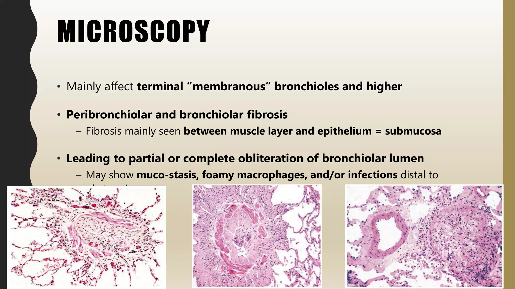 MICROSCOPY
• Mainly affect terminal “membranous” bronchioles and higher
• Peribronchiolar and bronchiolar fibrosis
– Fibrosis mainly seen between muscle layer and epithelium = submucosa
• Leading to partial or complete obliteration of bronchiolar lumen
– May show muco-stasis, foamy macrophages, and/or infections distal to
obstruction
 