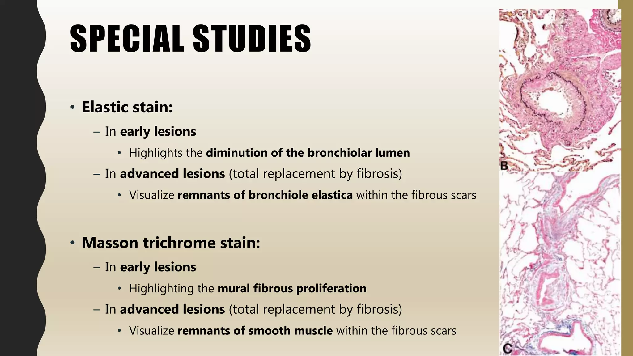 SPECIAL STUDIES
• Elastic stain:
– In early lesions
• Highlights the diminution of the bronchiolar lumen
– In advanced lesions (total replacement by fibrosis)
• Visualize remnants of bronchiole elastica within the fibrous scars
• Masson trichrome stain:
– In early lesions
• Highlighting the mural fibrous proliferation
– In advanced lesions (total replacement by fibrosis)
• Visualize remnants of smooth muscle within the fibrous scars
 