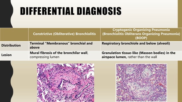 FlashPath- Lung - Constrictive (Obliterative) Bronchiolitis | PPT