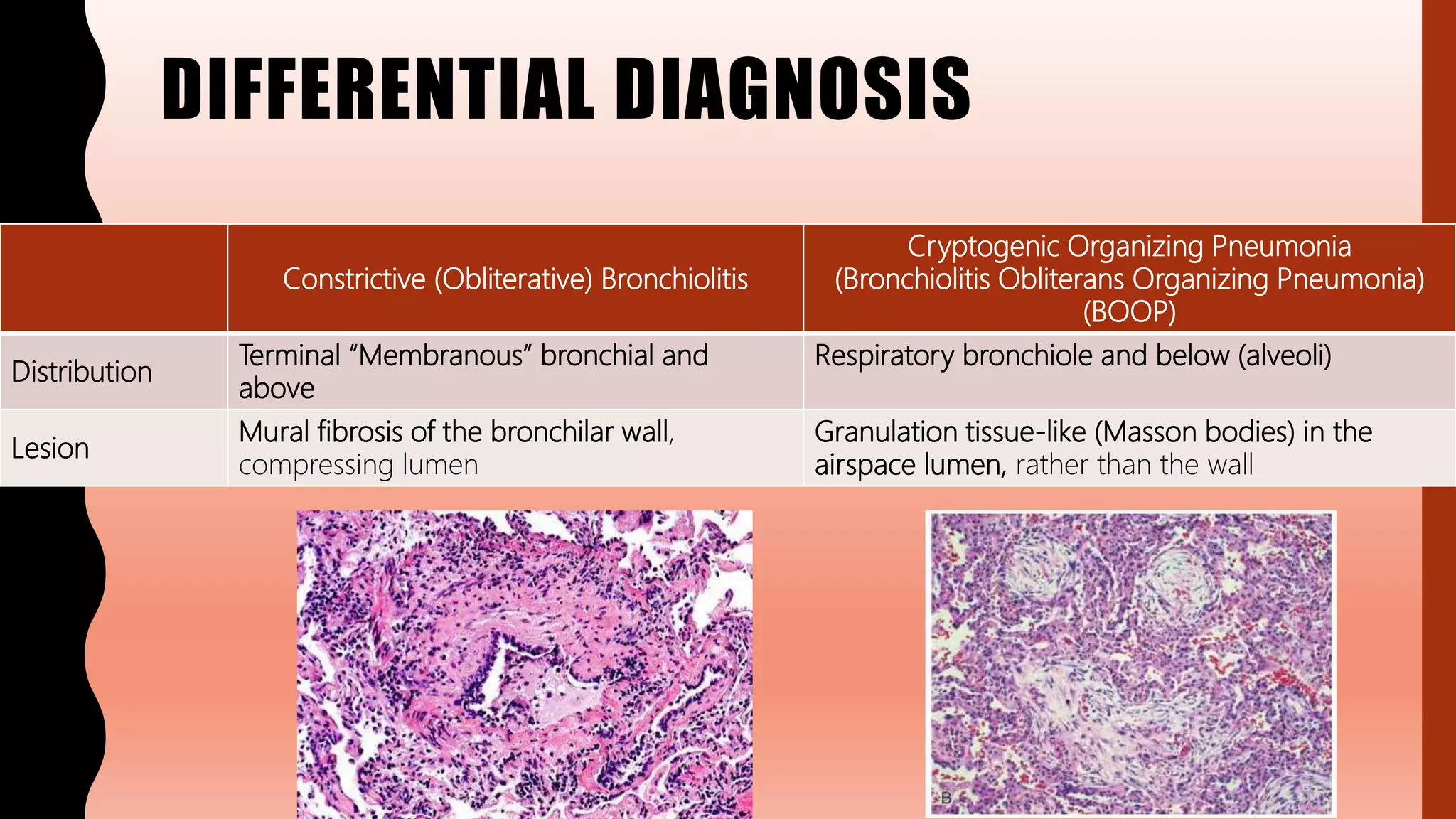 FlashPath - Lung - Cryptogenic Organizing Pneumonia (Bronchiolitis ...