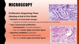 MICROSCOPY
Proliferative (Organizing) Phase
(Starting at End of First Week)
• Resolution of acute phase changes
– Fragments of hyaline membranes may incorporated into interstitium
• Type 2 pneumocyte proliferation
– Cuboidalization” of alveolar epithelium
– May show reactive atypia and mitotic figures
• Squamous metaplasia (occasional)
– Bronchioles and peri-bronchiolar alveoli
– May show reactive atypia and mitotic figures
 