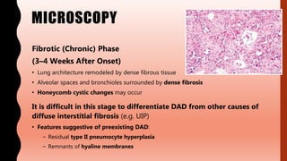 MICROSCOPY
Fibrotic (Chronic) Phase
(3–4 Weeks After Onset)
• Lung architecture remodeled by dense fibrous tissue
• Alveolar spaces and bronchioles surrounded by dense fibrosis
• Honeycomb cystic changes may occur
It is difficult in this stage to differentiate DAD from other causes of
diffuse interstitial fibrosis (e.g. UIP)
• Features suggestive of preexisting DAD:
– Residual type II pneumocyte hyperplasia
– Remnants of hyaline membranes
 