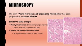 MICROSCOPY
The term “Acute Fibrinous and Organizing Pneumonia” has been
proposed as a variant of DAD
Similar to DAD except:
• Patchy involvement (Intervening lung is normal)
– rather than diffuse pattern of DAD
• Alveoli are filled with balls of fibrin
– No hyaline membranes as seen in DAD
 