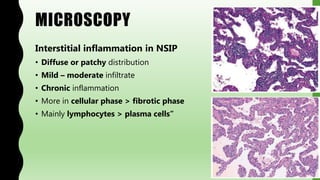 MICROSCOPY
Interstitial inflammation in NSIP
• Diffuse or patchy distribution
• Mild – moderate infiltrate
• Chronic inflammation
• More in cellular phase > fibrotic phase
• Mainly lymphocytes > plasma cells”
 
