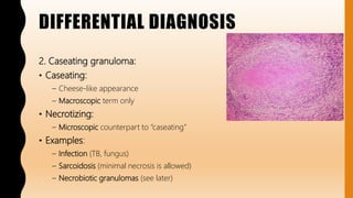 Caseated FlashPath- Lung - Pulmonary Hyalinizing Granuloma | PPTX