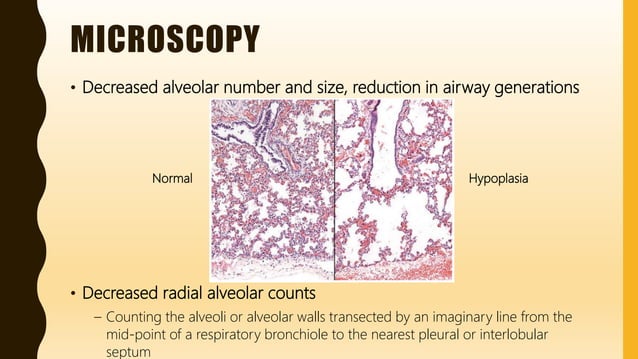FlashPath - Lung - Pulmonary Hypoplasia | PPTX | Lung and Respiratory ...