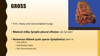 FlashPath - Lung - Pulmonary Lymphangiectasis | PPTX