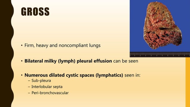 FlashPath - Lung - Pulmonary Lymphangiectasis | PPTX | Lung and ...