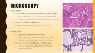 MICROSCOPY
• Intra-lobar:
– Marked chronic inflammation, fibrosis, cystic changes
• May be because it can be undiagnosed for long time,
it shows a higher risk for recurrent infections and fibrosis
– Not associated with CPAM type 2
(Congenital pulmonary airway malformation)
• Extra-lobar:
– No significant inflammation or fibrosis
• May be because it is often discovered early in life,
there is no time to develop infections or fibrosis
– Associated with (CPAM) type 2 in 50% of cases
• Areas of irregular, markedly dilated bronchioles
within parenchyma
 