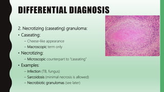 Noncaseating Necrosis FlashPath - Sarcoidosis | PPTX