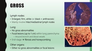 FlashPath - Sarcoidosis | PPTX