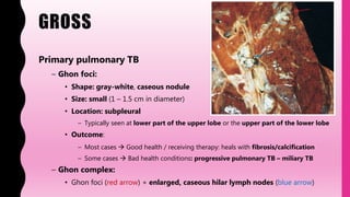 GROSS
Primary pulmonary TB
– Ghon foci:
• Shape: gray-white, caseous nodule
• Size: small (1 – 1.5 cm in diameter)
• Location: subpleural
– Typically seen at lower part of the upper lobe or the upper part of the lower lobe
• Outcome:
– Most cases  Good health / receiving therapy: heals with fibrosis/calcification
– Some cases  Bad health conditions: progressive pulmonary TB – miliary TB
– Ghon complex:
• Ghon foci (red arrow) + enlarged, caseous hilar lymph nodes (blue arrow)
 