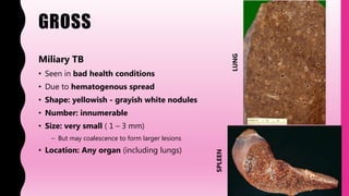 GROSS
Miliary TB
• Seen in bad health conditions
• Due to hematogenous spread
• Shape: yellowish - grayish white nodules
• Number: innumerable
• Size: very small ( 1 – 3 mm)
– But may coalescence to form larger lesions
• Location: Any organ (including lungs)
LUNG
SPLEEN
 