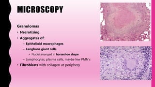 MICROSCOPY
Granulomas
• Necrotizing
• Aggregates of:
– Epithelioid macrophages
– Langhans giant cells
• Nuclei arranged in horseshoe shape
– Lymphocytes, plasma cells, maybe few PMN's
• Fibroblasts with collagen at periphery
 