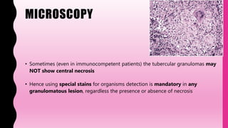 MICROSCOPY
• Sometimes (even in immunocompetent patients) the tubercular granulomas may
NOT show central necrosis
• Hence using special stains for organisms detection is mandatory in any
granulomatous lesion, regardless the presence or absence of necrosis
 