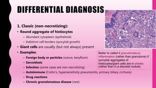 DIFFERENTIAL DIAGNOSIS
1. Classic (non-necrotizing):
• Round aggregate of histiocytes
– Abundant cytoplasm (epithelioid)
– Indistinct cell borders (syncytial growth)
• Giant cells are usually (but not always) present
• Examples:
– Foreign body or particles (suture, beryllium)
– Sarcoidosis
– Infection (some cases are non-necrotizing)
– Autoimmune (Crohn’s, hypersensitivity pneumonitis, primary biliary cirrhosis)
– Drug reactions
– Chronic granulomatous disease (rare)
Better to called it granulomatous
inflammation (rather than granuloma) if
syncytial aggregates of
histiocytes/giant cells are in sheets
(rather than in a discreet nodule)
 