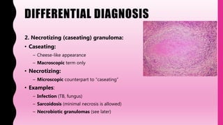 DIFFERENTIAL DIAGNOSIS
2. Necrotizing (caseating) granuloma:
• Caseating:
– Cheese-like appearance
– Macroscopic term only
• Necrotizing:
– Microscopic counterpart to “caseating”
• Examples:
– Infection (TB, fungus)
– Sarcoidosis (minimal necrosis is allowed)
– Necrobiotic granulomas (see later)
 