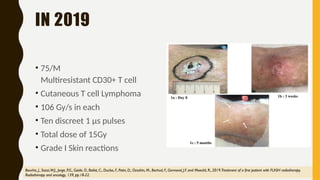 Flash RT- flash radiation therapy .pptx