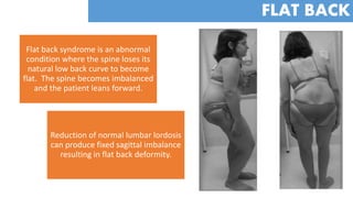 FAQs about Flatback Syndrome