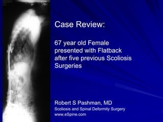 Case Review:

67 year old Female
presented with Flatback
after five previous Scoliosis
Surgeries




Robert S Pashman, MD
Scoliosis and Spinal Deformity Surgery
www.eSpine.com
 
