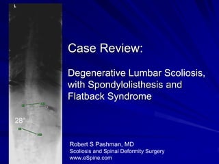 Case Review:
      Degenerative Lumbar Scoliosis,
      with Spondylolisthesis and
      Flatback Syndrome

28°


      Robert S Pashman, MD
      Scoliosis and Spinal Deformity Surgery
      www.eSpine.com
 