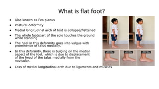 What is flat foot?
● Also known as Pes planus
● Postural deformity
● Medial longitudinal arch of foot is collapse/flattened
● The whole foot/part of the sole touches the ground
while standing
● The heel in this deformity goes into valgus with
prominence of talus medially.
● In this deformity, there is bulging on the medial
aspect of the foot, which is due to displacement
of the head of the talus medially from the
navicular.
● Loss of medial longitudinal arch due to ligaments and muscles
 