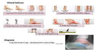 Diagnosis
X-ray-foot shows C-sign , developing from a bony bridge
Clinical features
1. Lowering of the Dome on the medial side of the foot 2. Inward Turned Ankle (Hindfoot Valgus)
4. Ankle and Foot pain
3. Weight Bearing on the Medial aspect of the foot
5. Tip toes Walking/Running
 