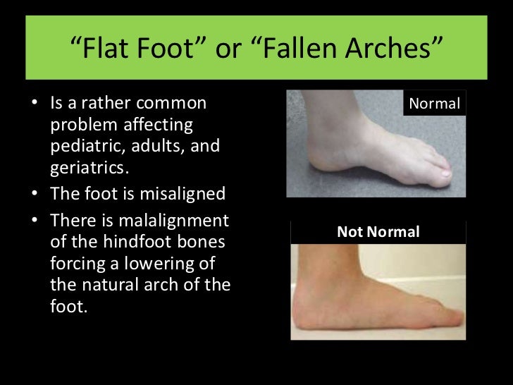 Flatfoot versus Talotarsal Displacement