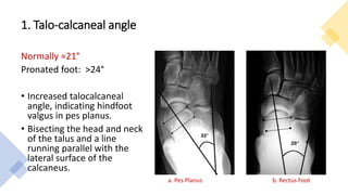 1. Talo-calcaneal angle
Normally ≈21°
Pronated foot: >24°
• Increased talocalcaneal
angle, indicating hindfoot
valgus in pes planus.
• Bisecting the head and neck
of the talus and a line
running parallel with the
lateral surface of the
calcaneus.
a. Pes Planus b. Rectus Foot
 