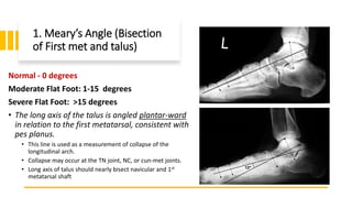 1. Meary’s Angle (Bisection
of First met and talus)
Normal - 0 degrees
Moderate Flat Foot: 1-15 degrees
Severe Flat Foot: >15 degrees
• The long axis of the talus is angled plantar-ward
in relation to the first metatarsal, consistent with
pes planus.
• This line is used as a measurement of collapse of the
longitudinal arch.
• Collapse may occur at the TN joint, NC, or cun-met joints.
• Long axis of talus should nearly bisect navicular and 1st
metatarsal shaft
 