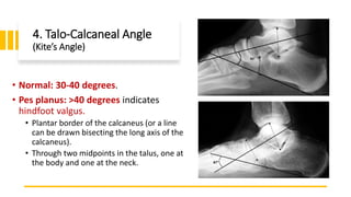4. Talo-Calcaneal Angle
(Kite’s Angle)
• Normal: 30-40 degrees.
• Pes planus: >40 degrees indicates
hindfoot valgus.
• Plantar border of the calcaneus (or a line
can be drawn bisecting the long axis of the
calcaneus).
• Through two midpoints in the talus, one at
the body and one at the neck.
 