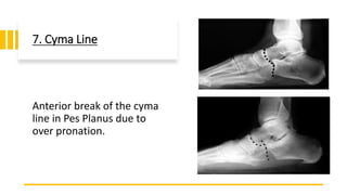 7. Cyma Line
Anterior break of the cyma
line in Pes Planus due to
over pronation.
 