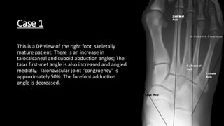 Case 1
This is a DP view of the right foot, skeletally
mature patient. There is an increase in
talocalcaneal and cuboid abduction angles; The
talar first-met angle is also increased and angled
medially. Talonavicular joint "congruency" is
approximately 50%. The forefoot adduction
angle is decreased.
 