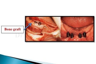 Flat ridge management