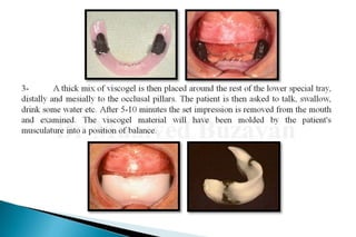 Flat ridge management