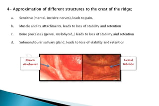 Flat ridge management