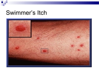 Swimmer’s Itch
 