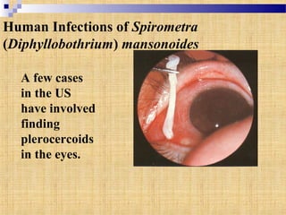 Human Infections of Spirometra
(Diphyllobothrium) mansonoides
A few cases
in the US
have involved
finding
plerocercoids
in the eyes.
 