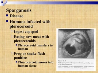 Sparganosis
 Disease
 Humans infected with
plerocercoid
Ingest copepod
Eating raw meat with
plerocercoids
 Plerocercoid transfers to
human
Frog or snake flesh
poultice
 Pluerocercoid moves into
human tissue
 