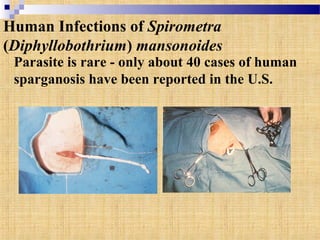 Parasite is rare - only about 40 cases of human
sparganosis have been reported in the U.S.
Human Infections of Spirometra
(Diphyllobothrium) mansonoides
 