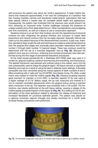 self-conscious the patient was about her smile’s appearance. A large midline dia-
stema that measured approximately 4 mm was the centerpiece of a dentition that
had missing maxillary canines and discolored metal-ceramic restorations that had
been placed without a master plan for complete dental health and appearance.
Consequently, the patient was frustrated that her previous care would prevent her
from achieving an improved smile. Further challenges included the presence of
a deep overbite and a thick deep labial frenum. Other considerations were budgeting
and time constraints, as well as a desire to use a conservative approach.
Diastema closure is an art form that involves not only the repositioning of proximal
surfaces but also integrating the gingival interface and occlusion to create ideal
proportions and natural contours that can be easily cleansed. Specialty referral was
ruled out by the patient because of the aforementioned concerns. A plan was, there-
fore, devised to laser sculpt the soft and hard tissue to create an external framework to
train the gingival (first stage) and eventually place porcelain restorations from teeth
number 4 through teeth number 14 (second stage). These new contours would be
determined with the aid of a mounted diagnostic wax-up (Fig. 22). Because the
patient’s time was at a minimum, whitening and occlusal procedures were also per-
formed during the first stage of periodontal-restorative procedures.
At the initial closed periodontal lift, a Waterlase ErCr:YSGG laser was used in 3
modes (ie, gingival sculpting, osseous recontouring and smoothing, and frenectomy).
The desired framework was planned and outlined using a fine marker, and a G-6 tip
was subsequently used to shape the gingival region. No tissue necrosis or significant
bleeding occurred as a result of using the laser’s relatively lower settings. A flowable
composite was then cemented along the mesial aspects of teeth numbers 8 and 9.
After smoothing with a “safe end” bur (H135TDF; Axis Dental, Irving, TX, USA), a solid
matrix was created to mold the midline papilla (Fig. 23). Osseous sculpting required
great precision to maintain a 3-mm DGC. A specially tapered T4 tip was used at
a higher wattage of 2.5 W. Before usage, the tip was measured and marked to 3
mm to maintain controlled adjustments within the gingival sulcus during a machine
stitch movement of the tip. The resection was smoothed with a 7/8 curette. The fre-
nectomy was cleanly performed at the soft tissue setting, causing a release of the
midline papilla and great freedom of the upper lip (Fig. 24). At a setting of 0.25 W, bio-
stimulation of the outer epithelium helped to decrease the release of histamine and
increased fibroblasts for junctional epithelial growth. The patient was placed on
a vigorous homecare regimen (Oxygel) and closely monitored for a month while
occlusal therapy procedures were performed.
Fig. 22. A mounted diagnostic wax-up is a critical road map to planning a realistic result.
Soft and Hard Tissue Management 397
 