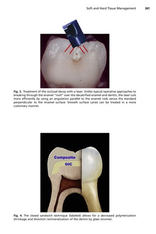 Fig. 3. Treatment of the occlusal decay with a laser. Unlike typical operative approaches to
breaking through the enamel “roof” over the decalcified enamel and dentin, the laser cuts
more efficiently by using an angulation parallel to the enamel rods versus the standard
perpendicular to the enamel surface. Smooth surface caries can be treated in a more
customary manner.
Fig. 4. The closed sandwich technique (labeled) allows for a decreased polymerization
shrinkage and direction remineralization of the dentin by glass ionomer.
Soft and Hard Tissue Management 387
 
