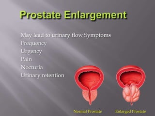 May lead to urinary flow Symptoms
Frequency
Urgency
Pain
Nocturia
Urinary retention
Normal Prostate Enlarged Prostate
 