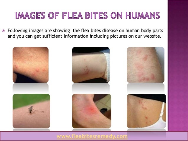 How Long do Flea Bites Last and How to Heal Them Faster